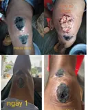 Bột Khô Sát Vết Thương – Giải Pháp Giúp Vết Thương Nhanh Lành, Nhanh Khô An Toàn - Bột Khô Y Sĩ - Ảnh 1