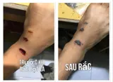 Bột Khô Sát Vết Thương – Giải Pháp Giúp Vết Thương Nhanh Lành, Nhanh Khô An Toàn - Bột Khô Y Sĩ - Ảnh 4