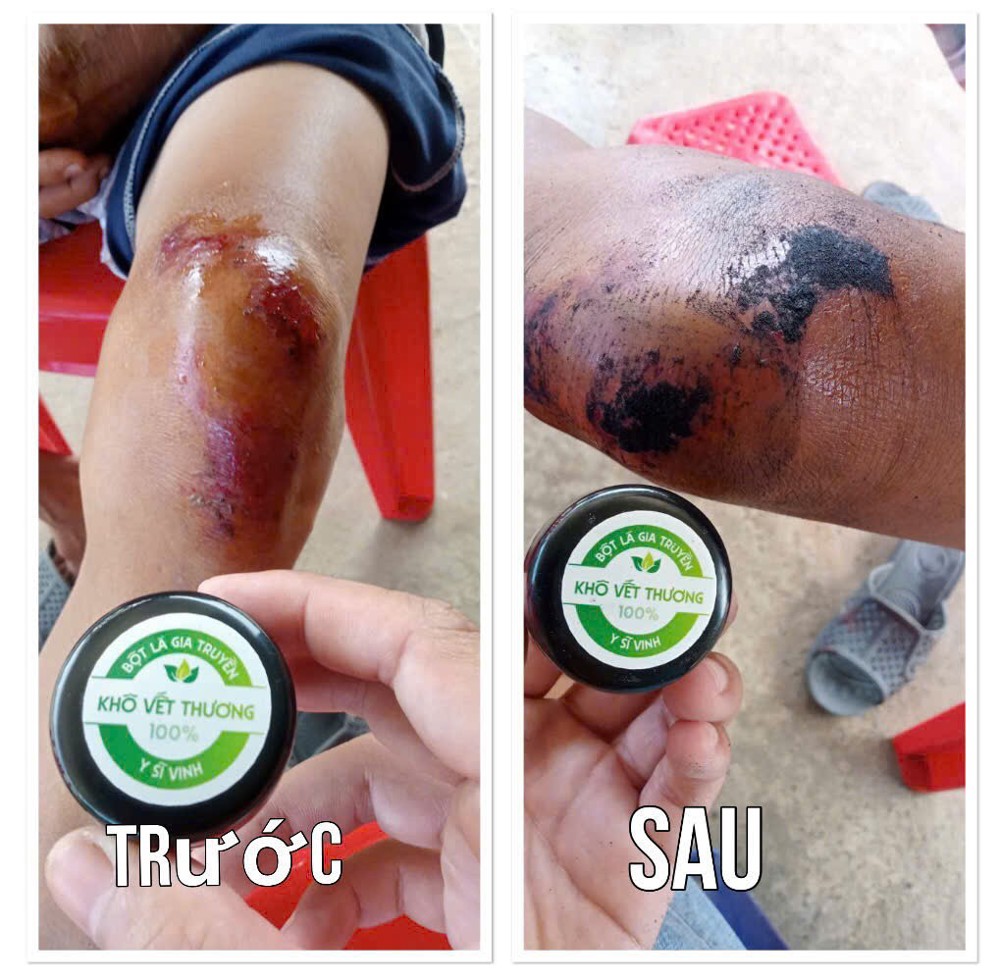 Bột Khô Sát Vết Thương – Giải Pháp Giúp Vết Thương Nhanh Lành, Nhanh Khô An Toàn - Bột Khô Y Sĩ