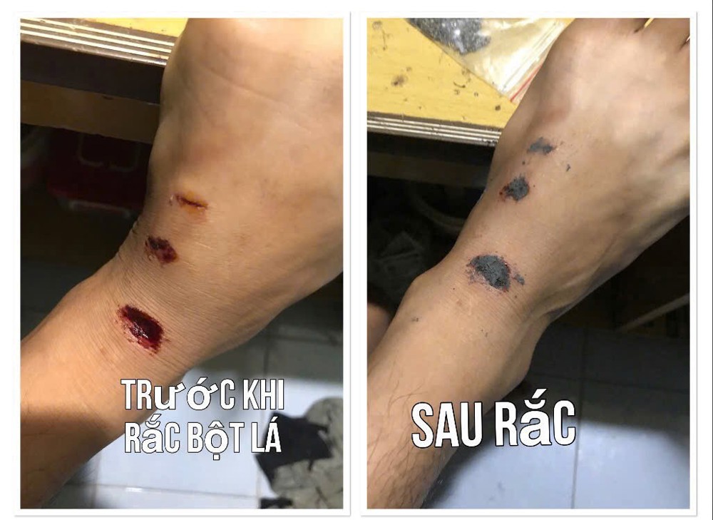 Bột Khô Sát Vết Thương – Giải Pháp Giúp Vết Thương Nhanh Lành, Nhanh Khô An Toàn - Bột Khô Y Sĩ