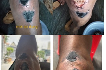 Bột Khô Sát Vết Thương – Giải Pháp Giúp Vết Thương Nhanh Lành, Nhanh Khô An Toàn - Bột Khô Y Sĩ